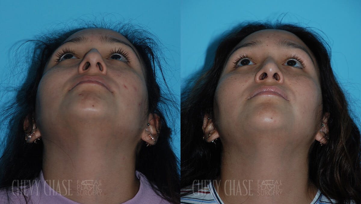 Rhinoplasty Before & After Gallery - Patient 106387622 - Image 5
