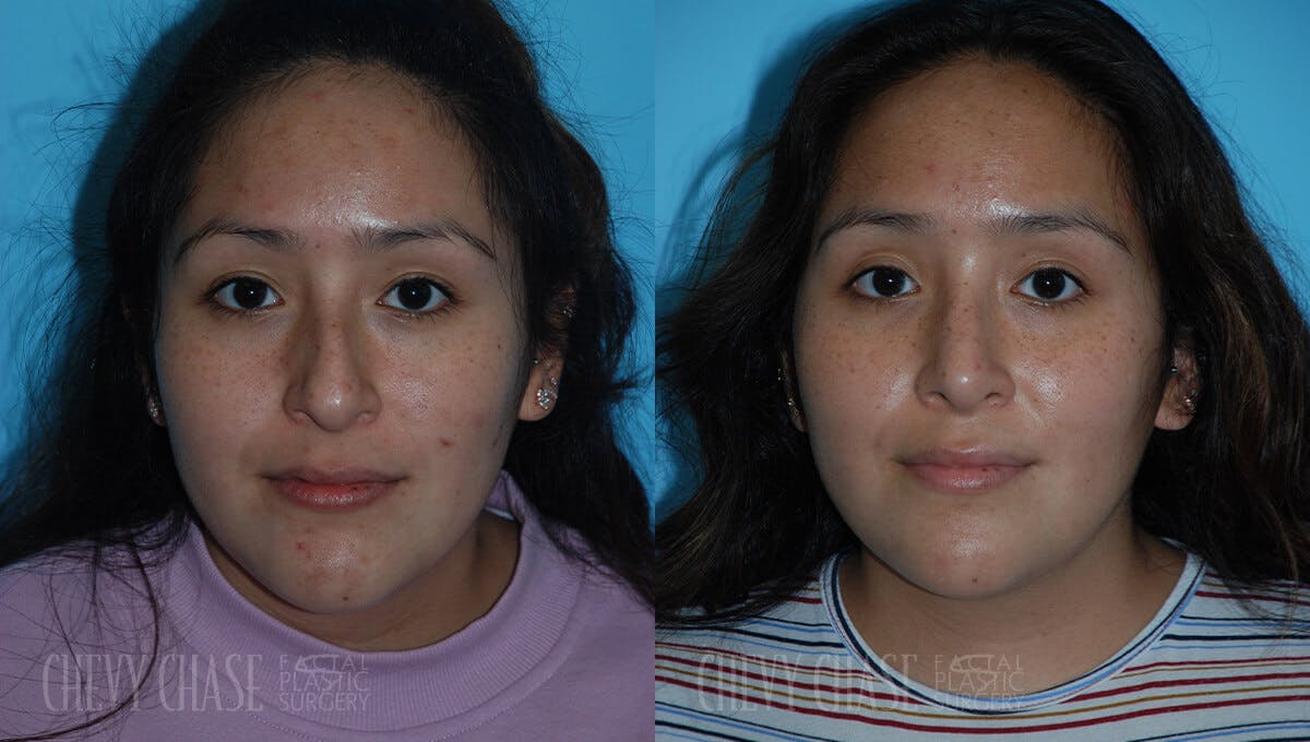 Rhinoplasty Before & After Gallery - Patient 106387622 - Image 6