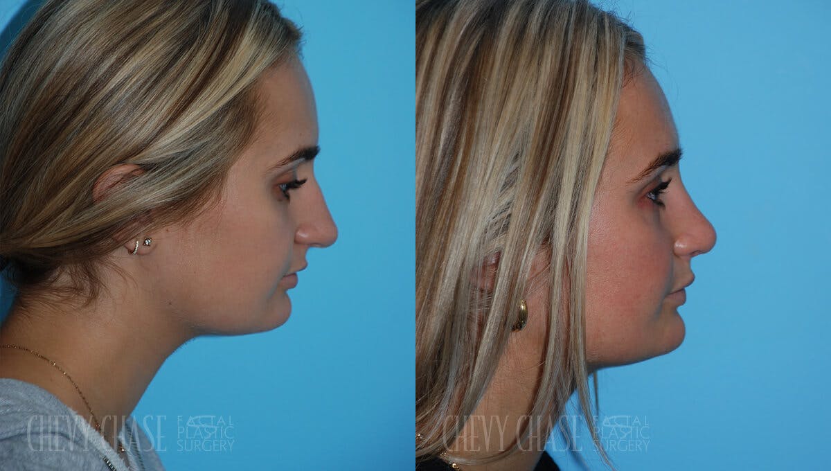 Rhinoplasty Before & After Gallery - Patient 106387623 - Image 1