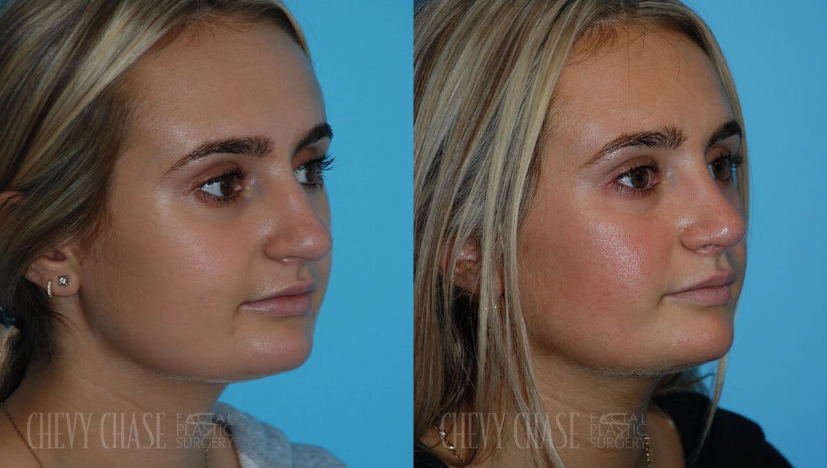 Rhinoplasty Before & After Gallery - Patient 106387623 - Image 2