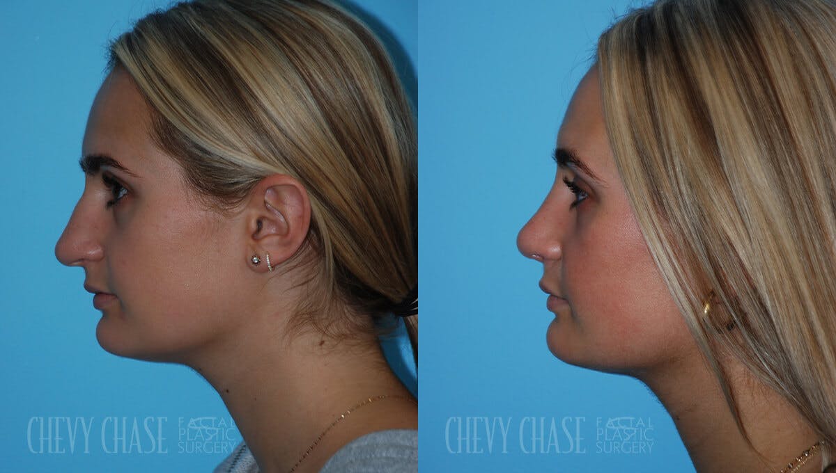 Rhinoplasty Before & After Gallery - Patient 106387623 - Image 3