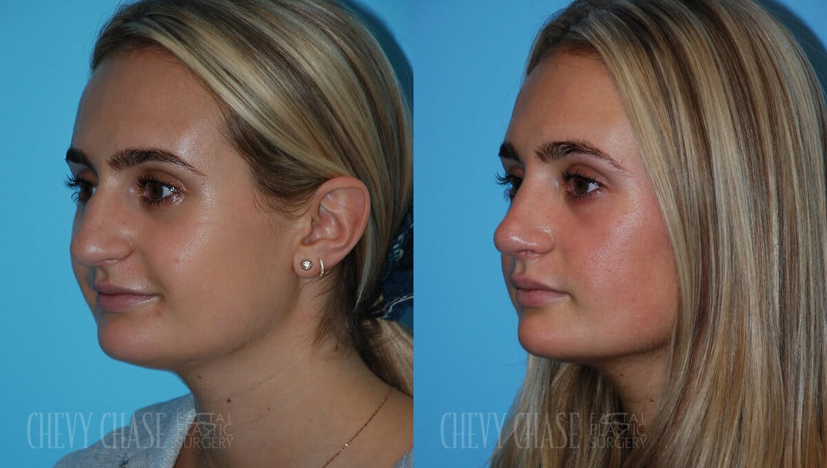 Rhinoplasty Before & After Gallery - Patient 106387623 - Image 4