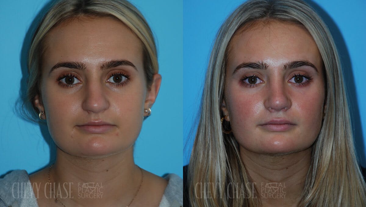 Rhinoplasty Before & After Gallery - Patient 106387623 - Image 5