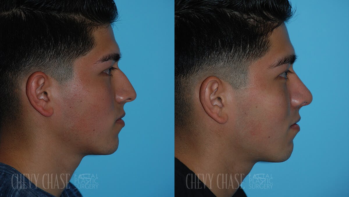Rhinoplasty Before & After Gallery - Patient 106387625 - Image 1