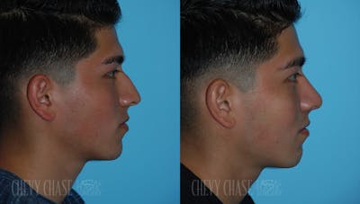 Rhinoplasty Before & After Gallery - Patient 106387625 - Image 1