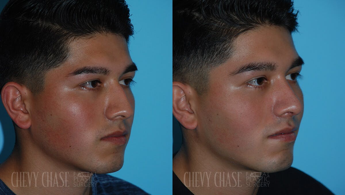 Rhinoplasty Before & After Gallery - Patient 106387625 - Image 2