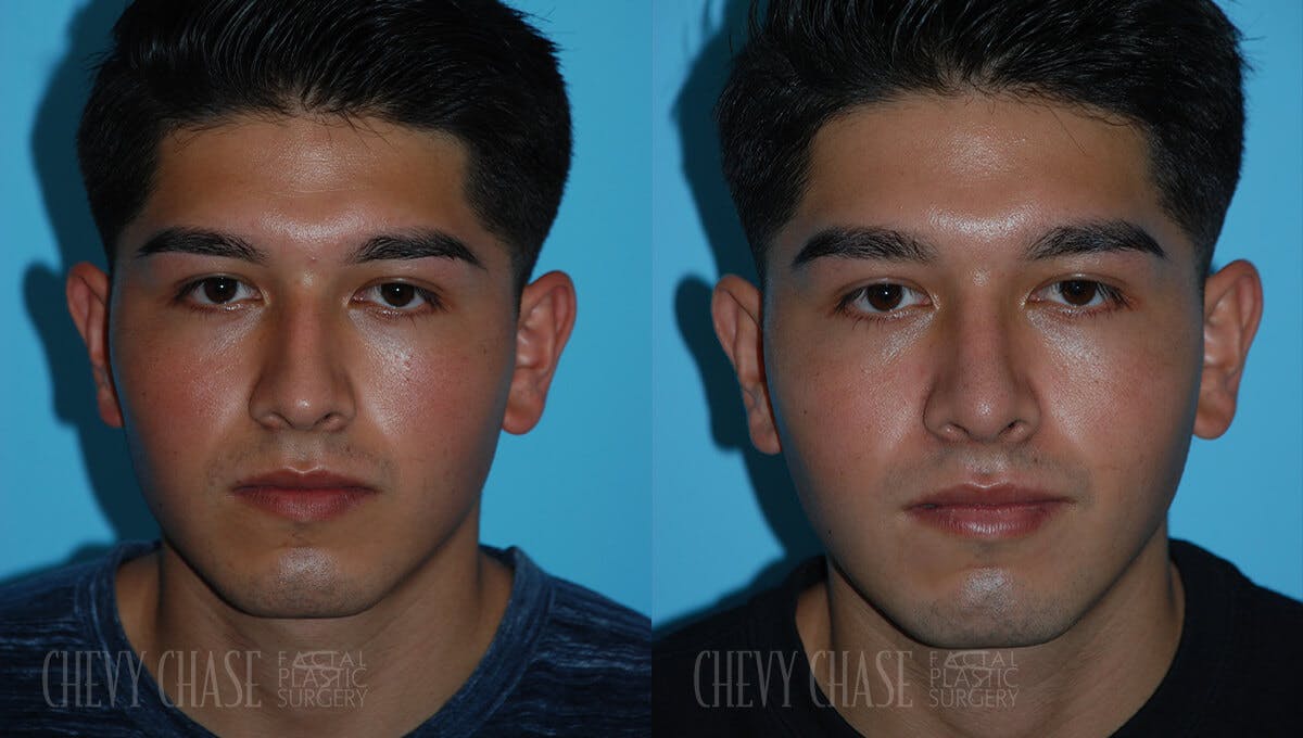 Rhinoplasty Before & After Gallery - Patient 106387625 - Image 3