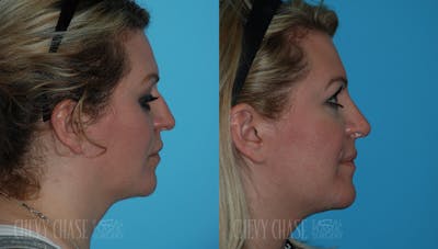 Rhinoplasty Before & After Gallery - Patient 106387627 - Image 1