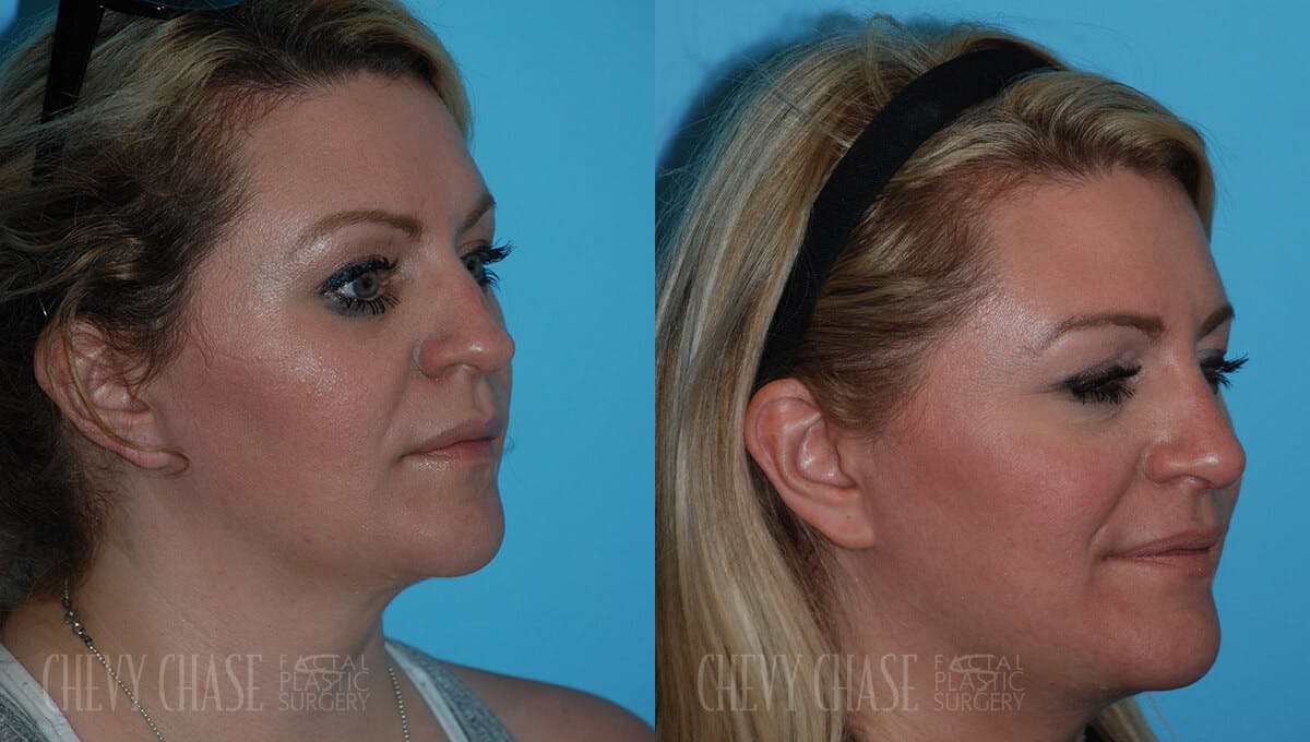 Rhinoplasty Before & After Gallery - Patient 106387627 - Image 2