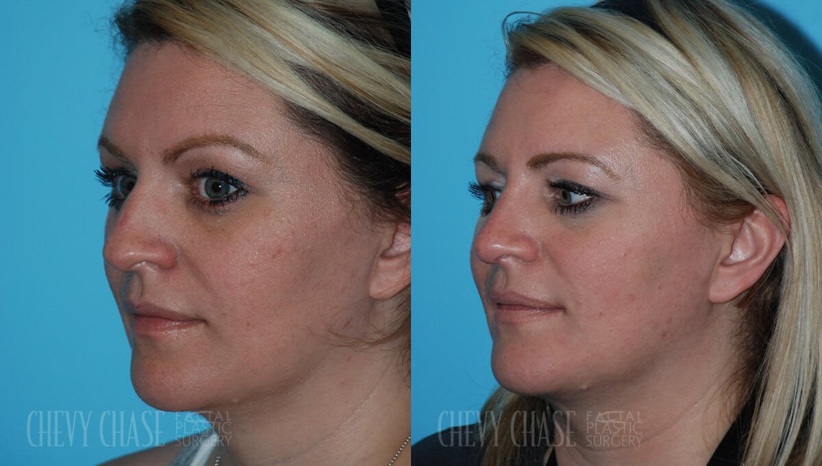 Rhinoplasty Before & After Gallery - Patient 106387627 - Image 3