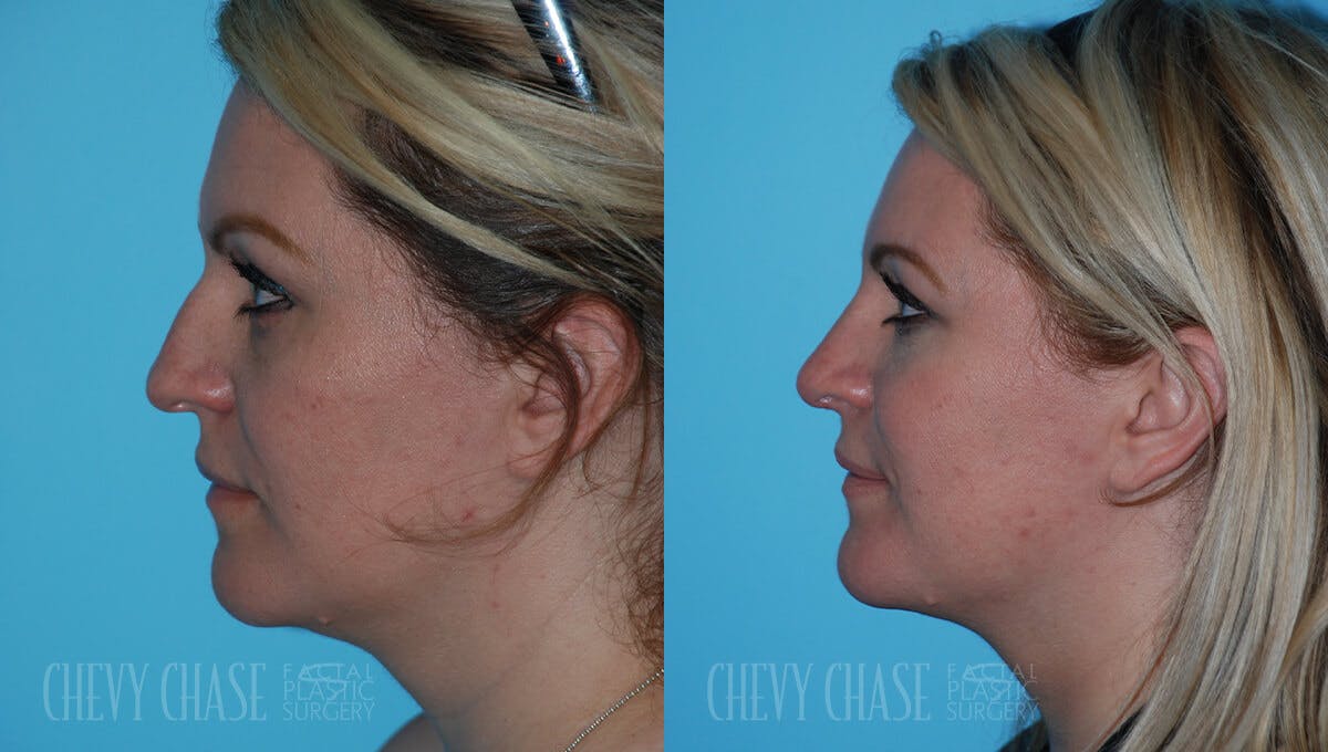 Rhinoplasty Before & After Gallery - Patient 106387627 - Image 4