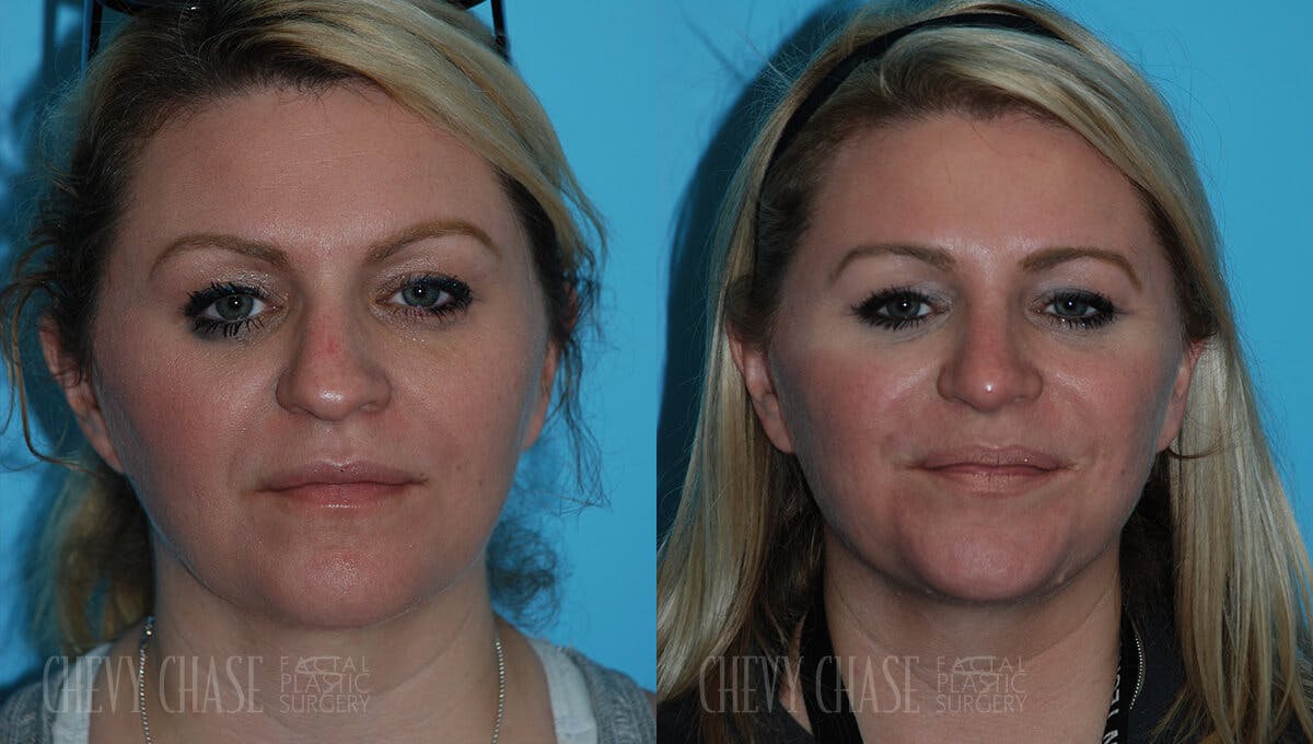 Rhinoplasty Before & After Gallery - Patient 106387627 - Image 5
