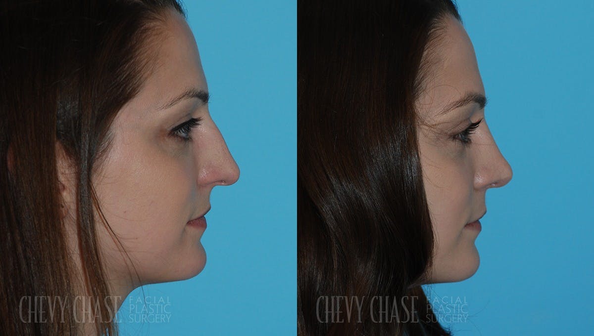 Rhinoplasty Before & After Gallery - Patient 106387628 - Image 1