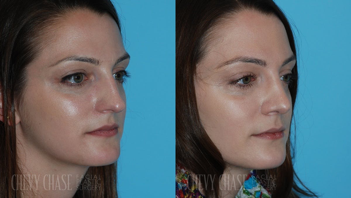 Rhinoplasty Before & After Gallery - Patient 106387628 - Image 2