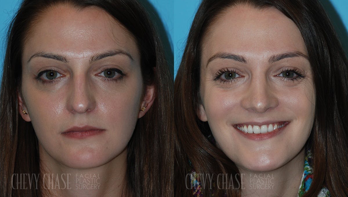 Rhinoplasty Before & After Gallery - Patient 106387628 - Image 3