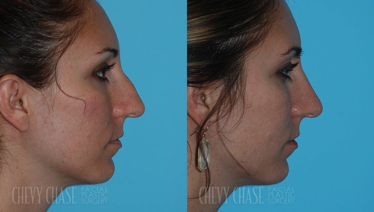 Rhinoplasty Before & After Gallery - Patient 106387632 - Image 1