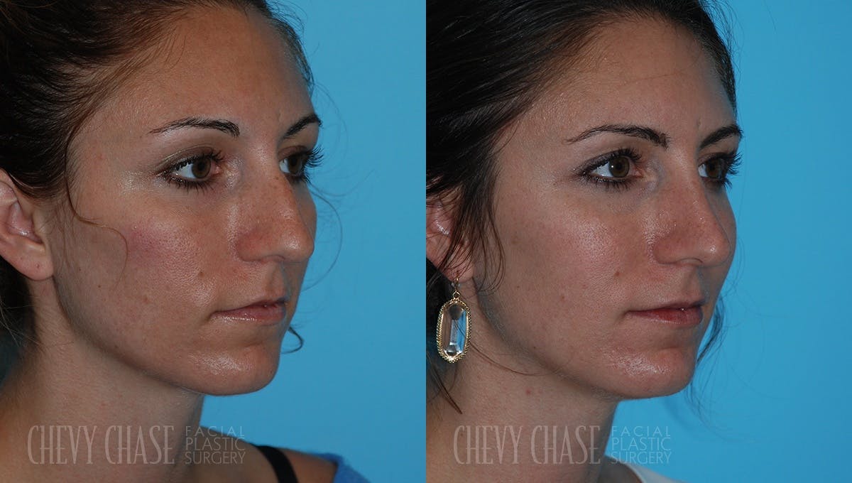 Rhinoplasty Before & After Gallery - Patient 106387632 - Image 2