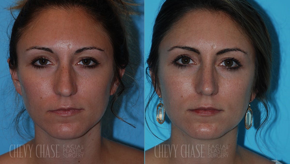 Rhinoplasty Before & After Gallery - Patient 106387632 - Image 3