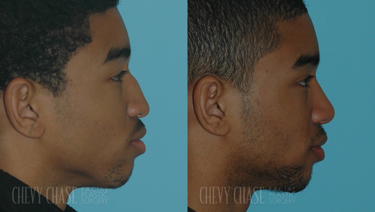 Rhinoplasty Before & After Gallery - Patient 106387647 - Image 1