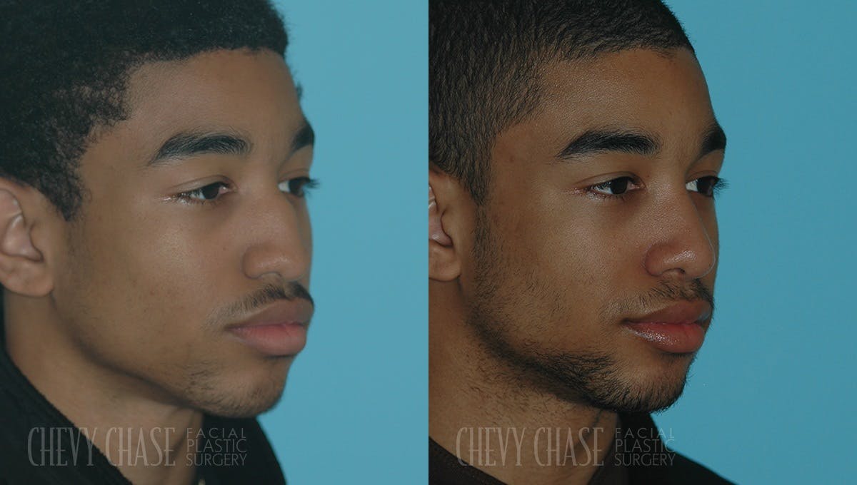 Rhinoplasty Before & After Gallery - Patient 106387647 - Image 2