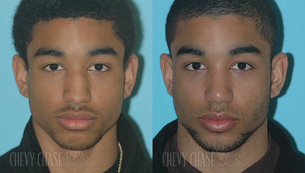 Rhinoplasty Before & After Gallery - Patient 106387647 - Image 3