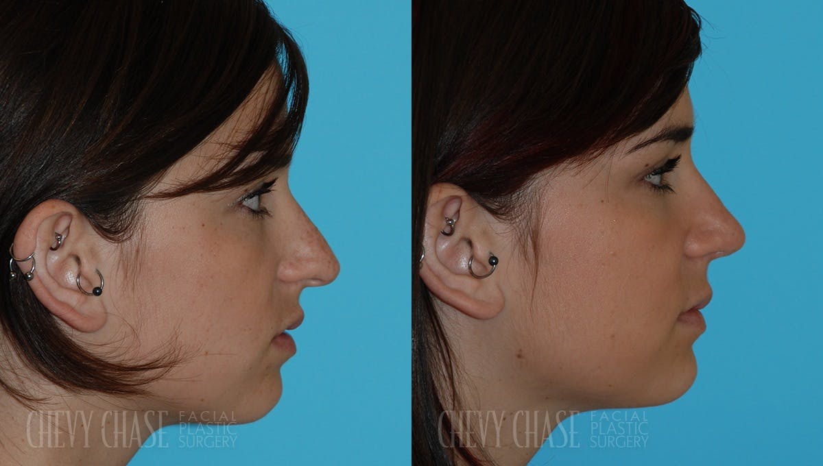 Rhinoplasty Before & After Gallery - Patient 106387652 - Image 1