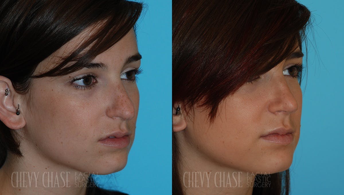 Rhinoplasty Before & After Gallery - Patient 106387652 - Image 2