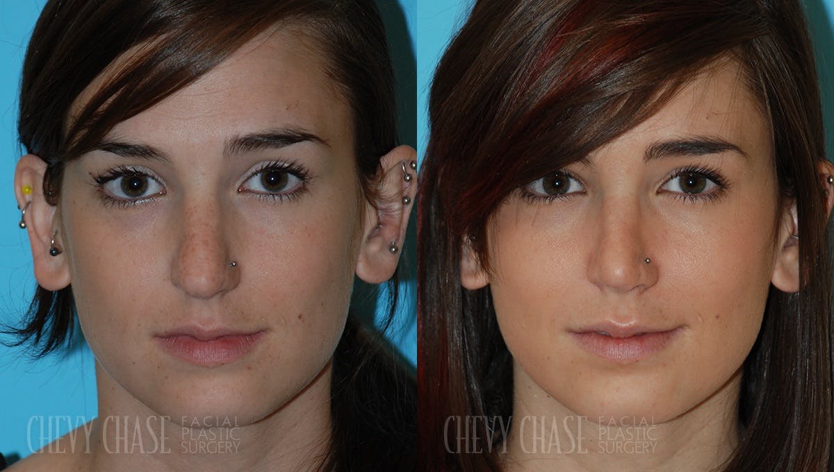 Rhinoplasty Before & After Gallery - Patient 106387652 - Image 3