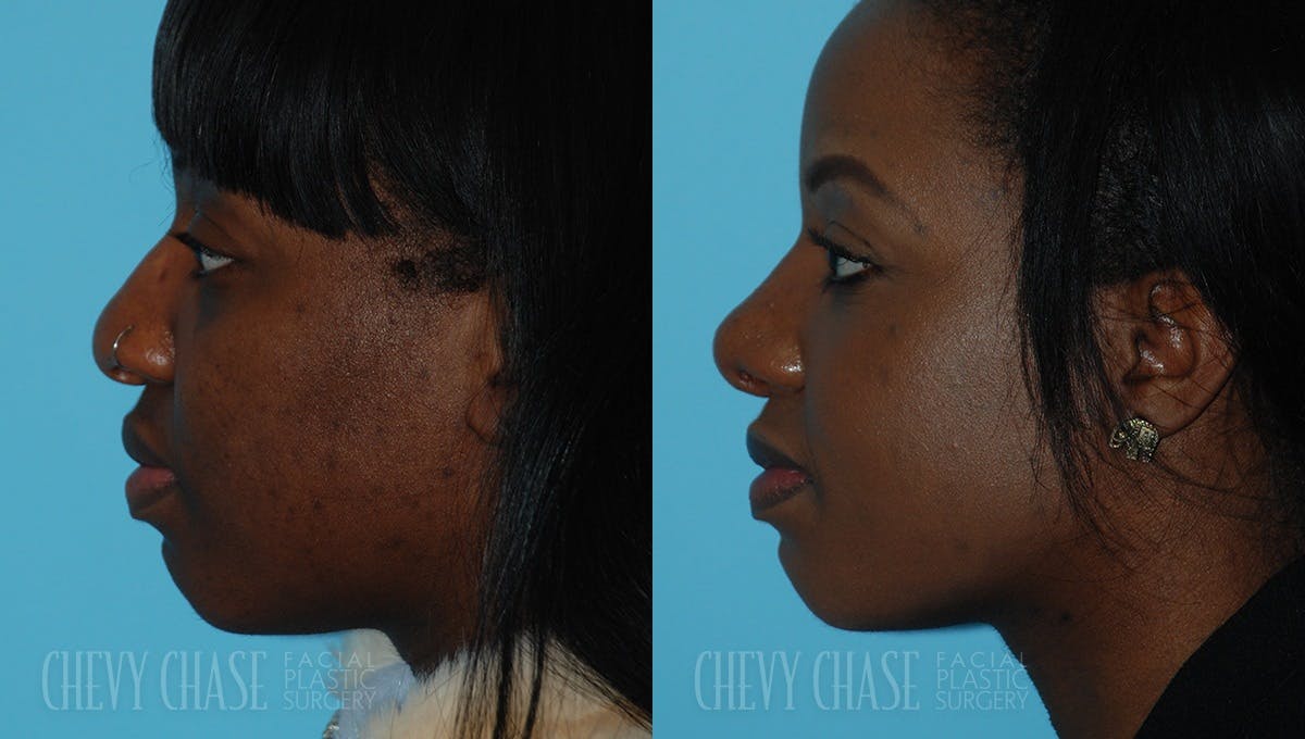 Rhinoplasty Before & After Gallery - Patient 106387654 - Image 1