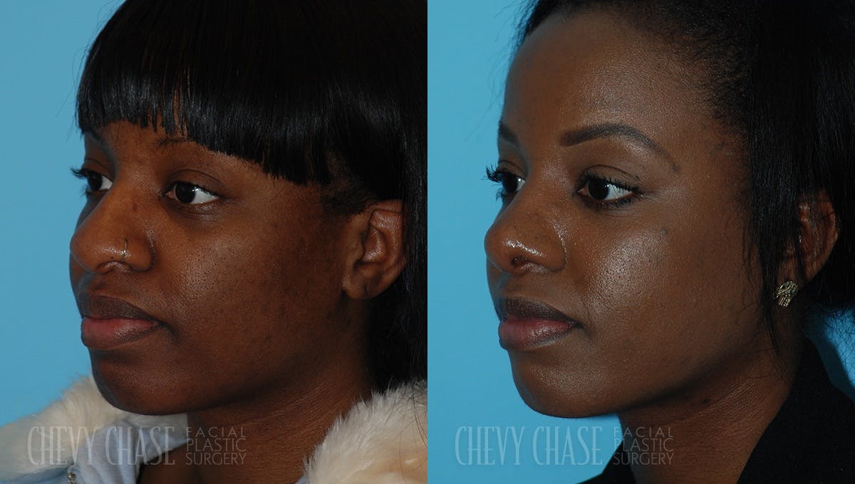 Rhinoplasty Before & After Gallery - Patient 106387654 - Image 2