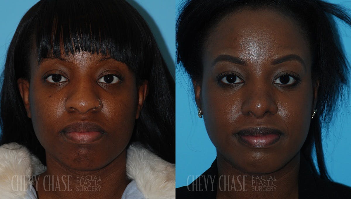 Rhinoplasty Before & After Gallery - Patient 106387654 - Image 3