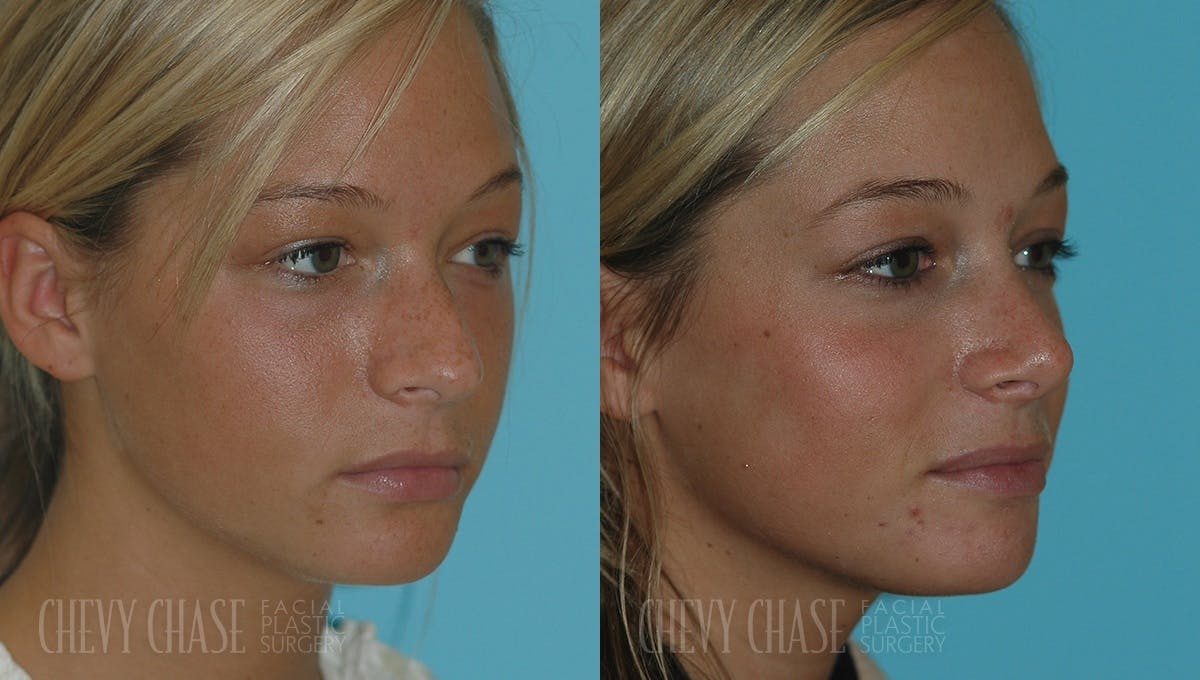 Rhinoplasty Before & After Gallery - Patient 106387658 - Image 1