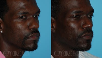 Rhinoplasty Before & After Gallery - Patient 106387660 - Image 1
