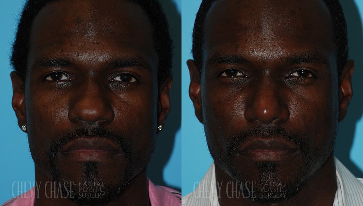 Rhinoplasty Before & After Gallery - Patient 106387660 - Image 2