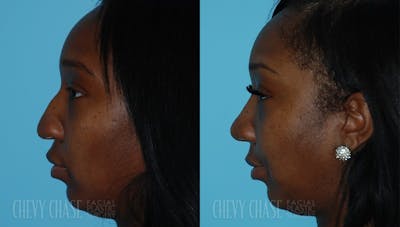 Rhinoplasty Before & After Gallery - Patient 106387661 - Image 1