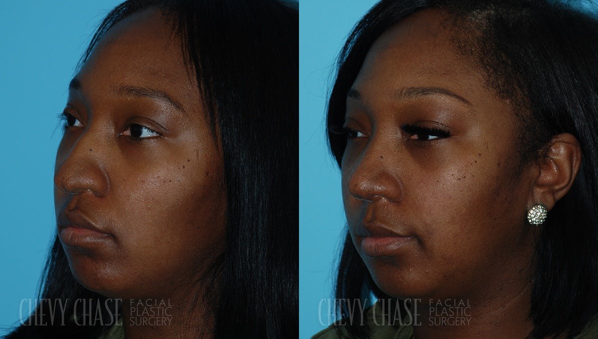 Rhinoplasty Before & After Gallery - Patient 106387661 - Image 2