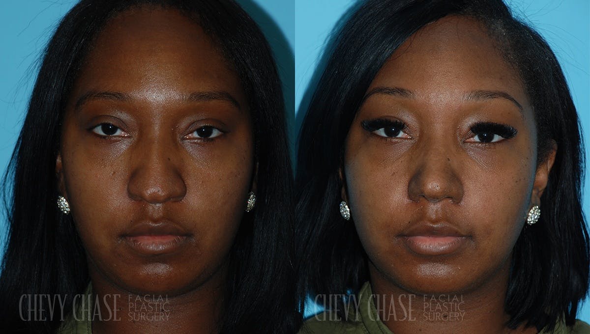 Rhinoplasty Before & After Gallery - Patient 106387661 - Image 3