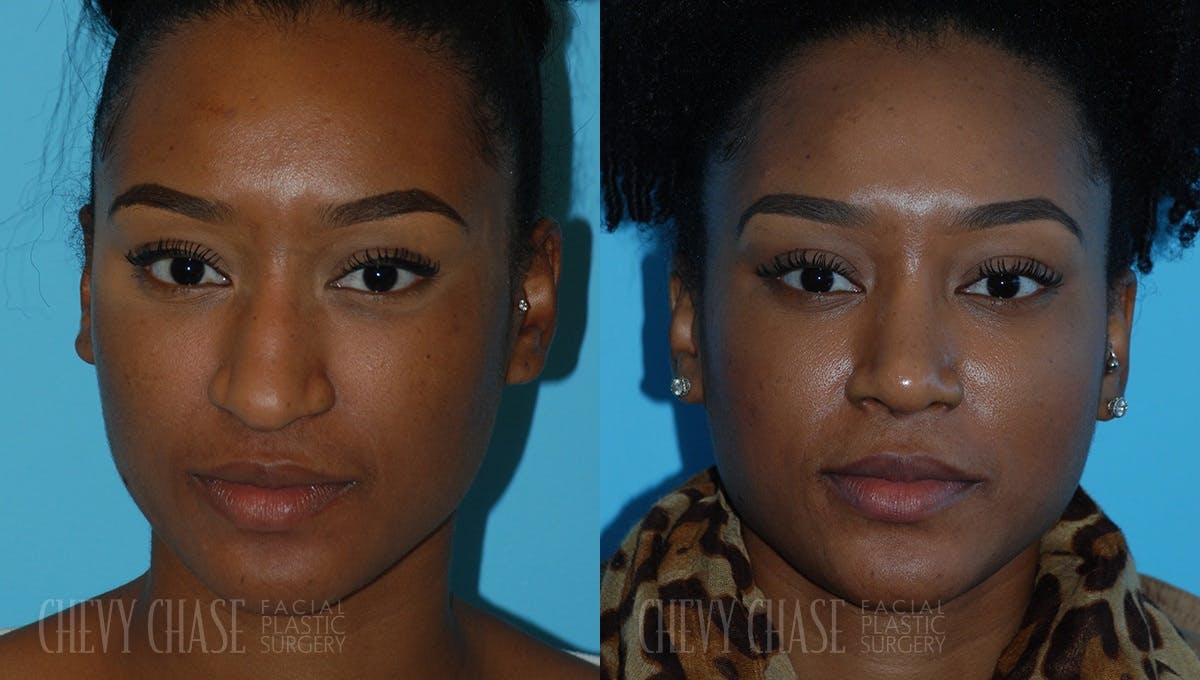 Rhinoplasty Before & After Gallery - Patient 106387663 - Image 1