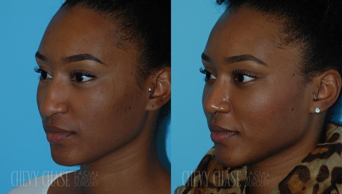 Rhinoplasty Before & After Gallery - Patient 106387663 - Image 2