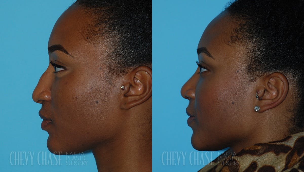 Rhinoplasty Before & After Gallery - Patient 106387663 - Image 3