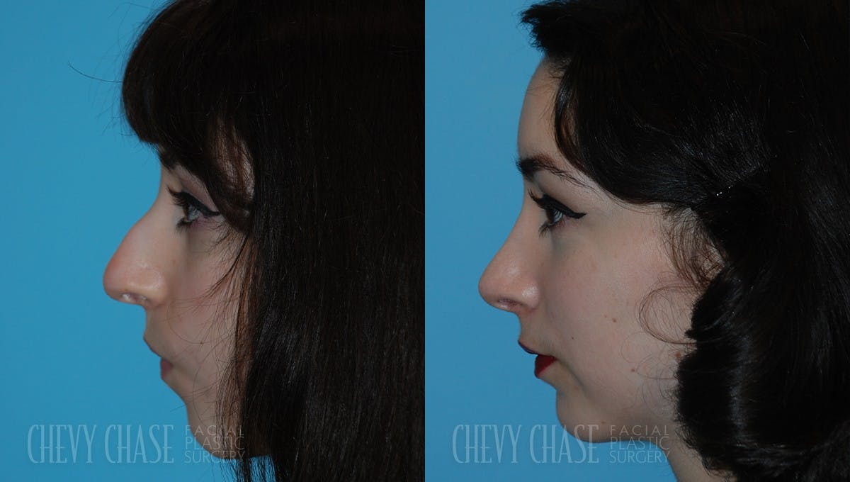 Rhinoplasty Before & After Gallery - Patient 106387665 - Image 1
