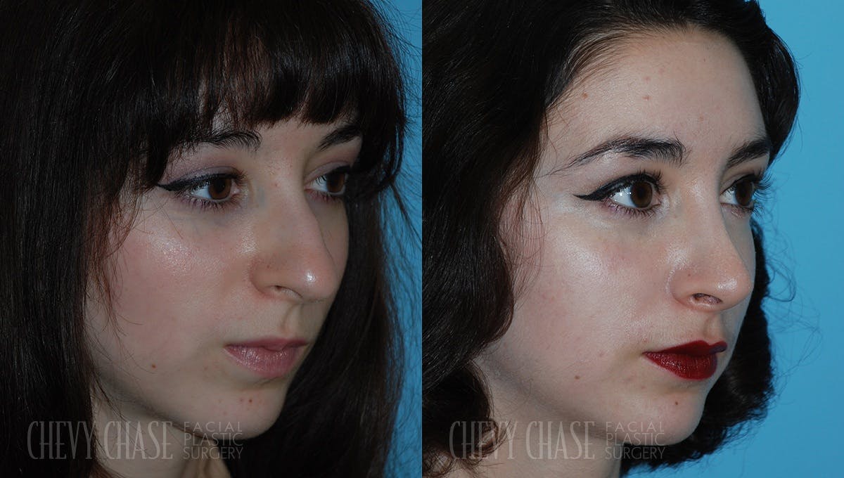 Rhinoplasty Before & After Gallery - Patient 106387665 - Image 2