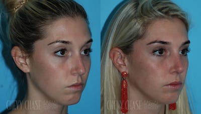 Rhinoplasty Before & After Gallery - Patient 106387666 - Image 1