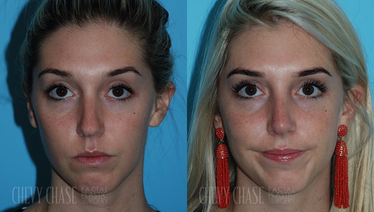 Rhinoplasty Before & After Gallery - Patient 106387666 - Image 2