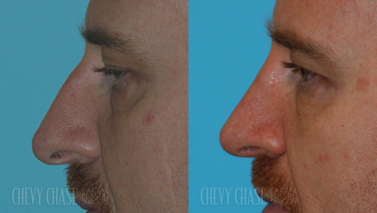 Rhinoplasty Before & After Gallery - Patient 106387667 - Image 1