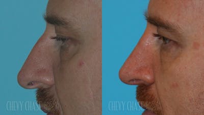 Rhinoplasty Before & After Gallery - Patient 106387667 - Image 1