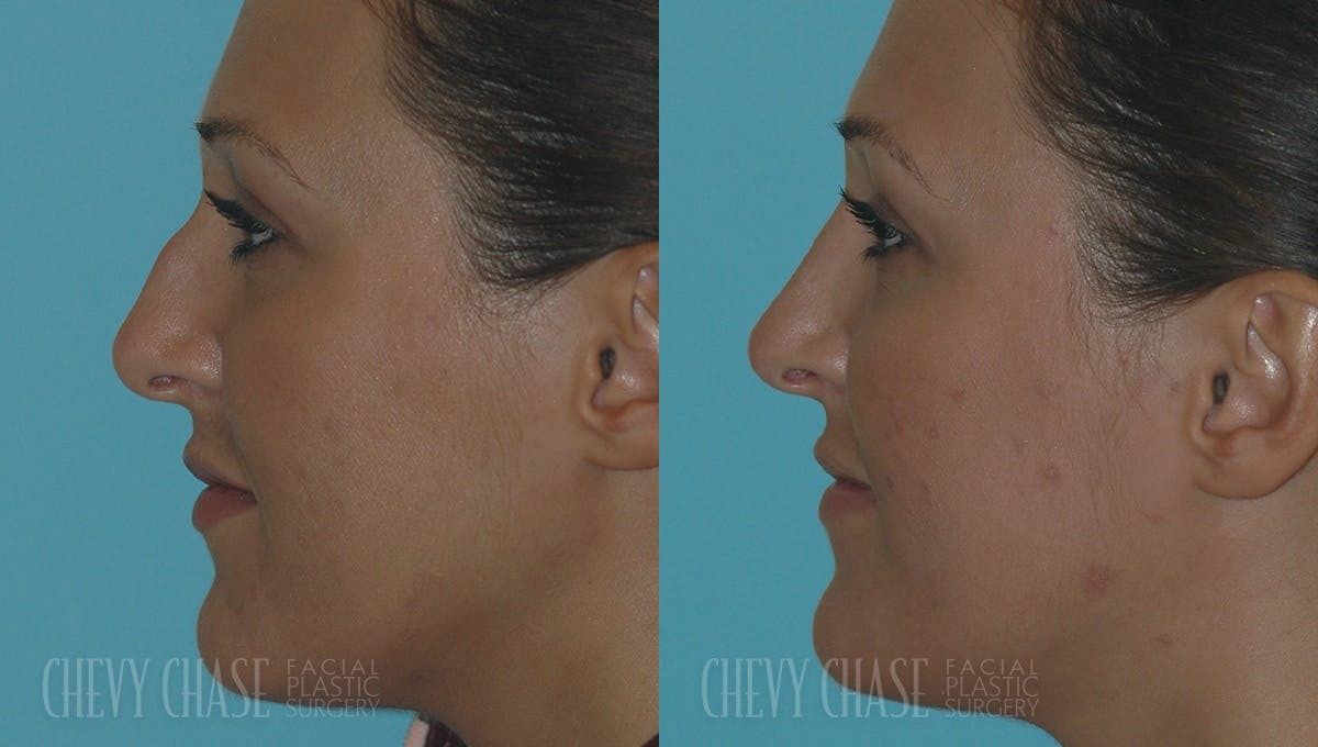 Rhinoplasty Before & After Gallery - Patient 106387668 - Image 1