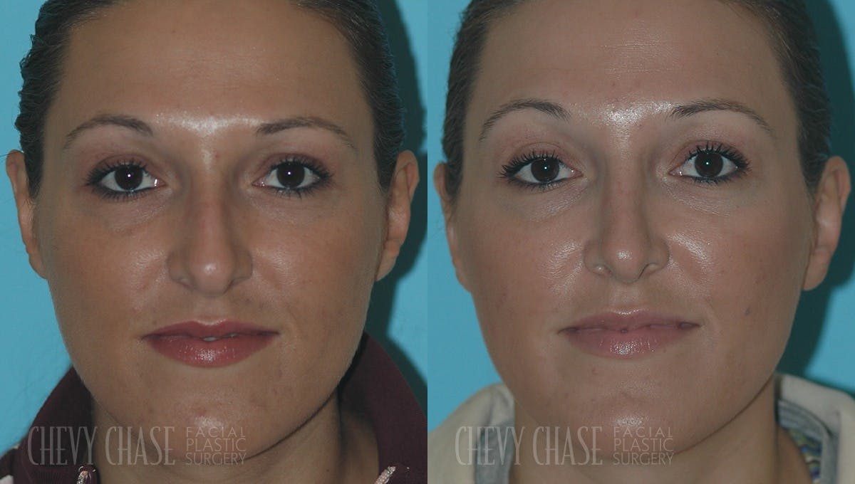 Rhinoplasty Before & After Gallery - Patient 106387668 - Image 2