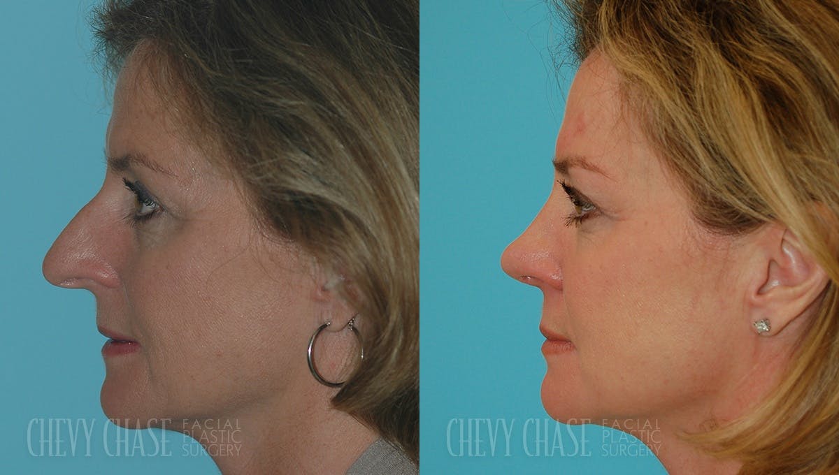 Rhinoplasty Before & After Gallery - Patient 106387670 - Image 1