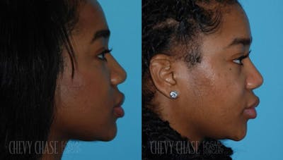 Rhinoplasty Before & After Gallery - Patient 106387678 - Image 1